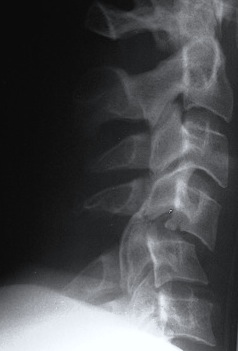 Cervical Bilateral Facet Joint Dislocation Xray
